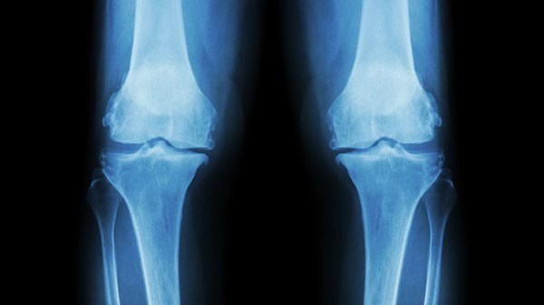 الذكاء الاصطناعي يتوقع تطور أمراض المفاصل بدقة غير مسبوقة