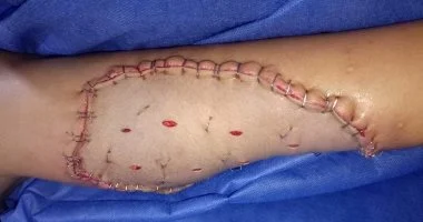 مستشفى دسوق العام ينجح في علاج إصابة طفلة عقب عضة كلب – تقرير مصور