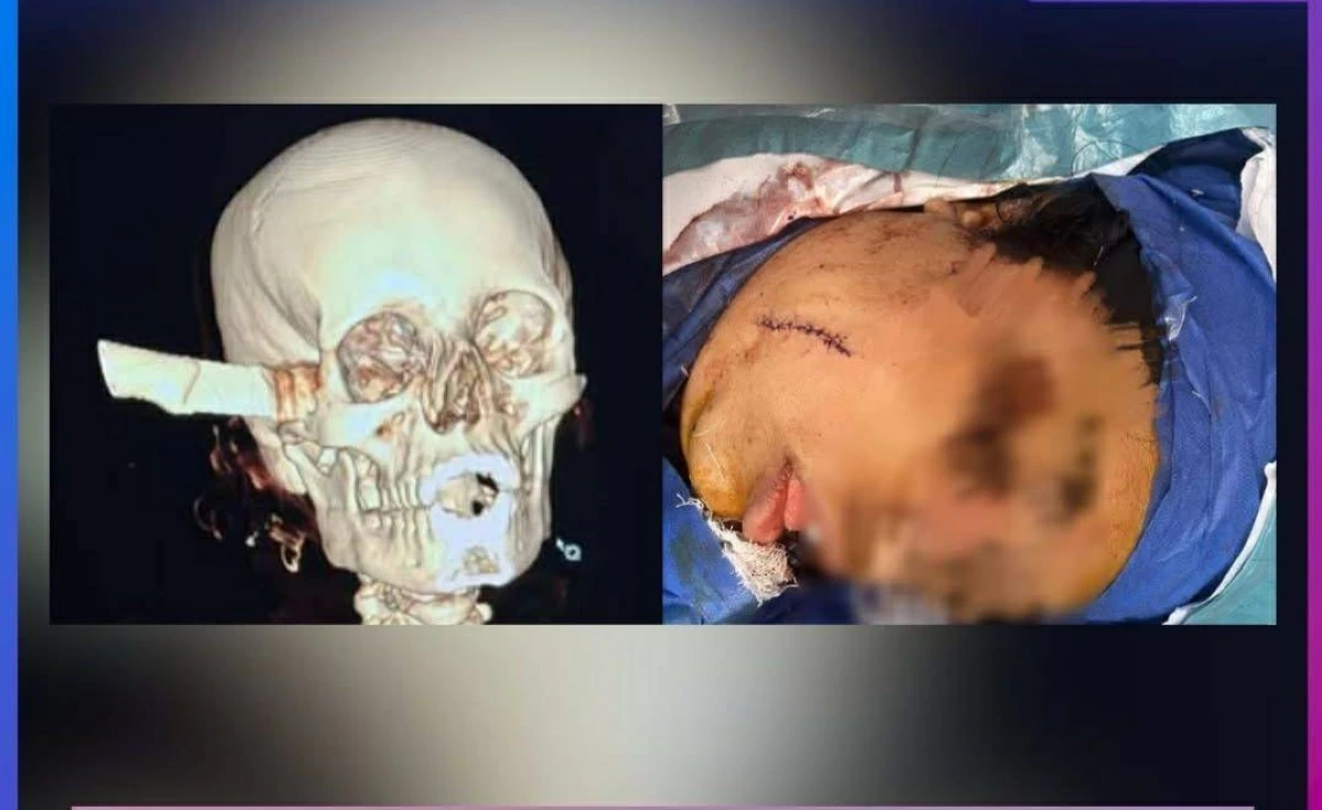 27 طعنة من خطيبها.. إنقاذ مصرية من الموت بمعجزة استخراج سكين من الجمجمة