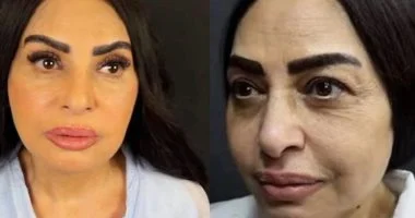 سلوى خطاب بعد عملية شد الوجه: كان عندى تكتلات دهنية فى وشى وشلتها