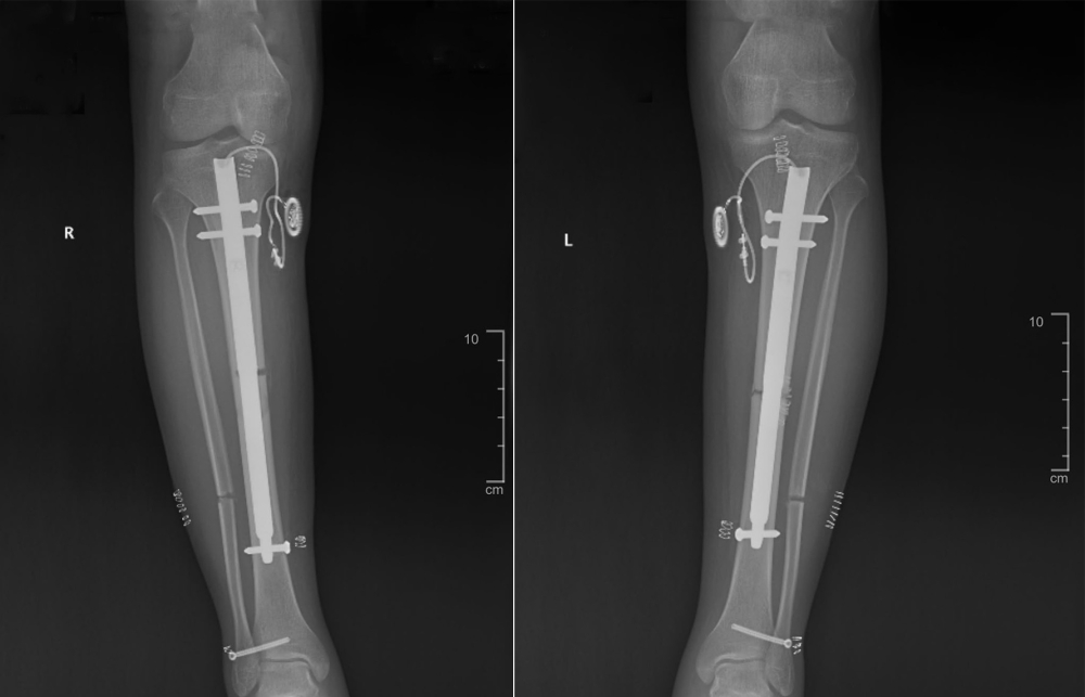 مستشفى الدكتور سليمان الحبيب بالخبر يجري عملية تطويل قامة بتقنية المسمار الكهربائي Fit Bone لأول مرة