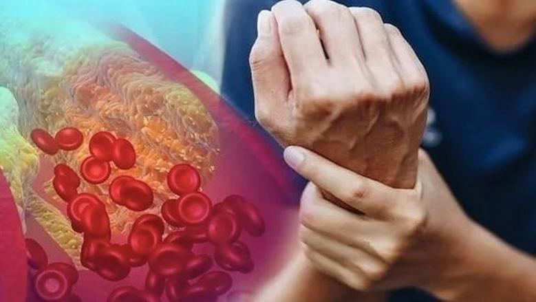كيف يزيد الكوليسترول الضار خطر الإصابة بالسكتة الدماغية؟.. 6 خطوات للوقاية منه