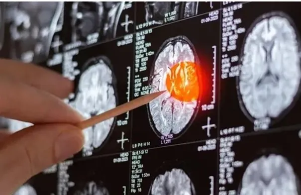 نقطة ضعف في سرطان الدماغ.. اكتشاف قد يساعد على منع عودة…