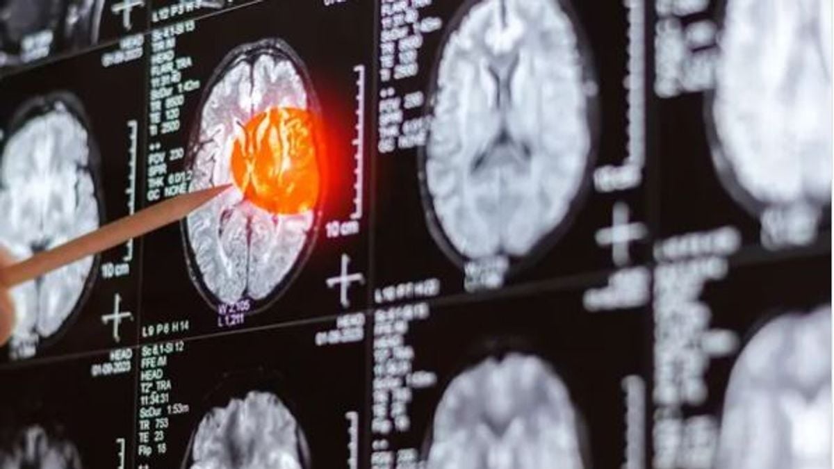باحثون يكتشفون نقطة ضعف بسرطان الدماغ قد تمنع عودته