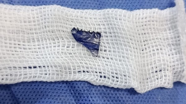 إنقاذ طفل من الاختناق بعد اكتشاف جزء من كيس مايونيز عالق بين الأحبال الصوتية بمستشفى أطفال بنها